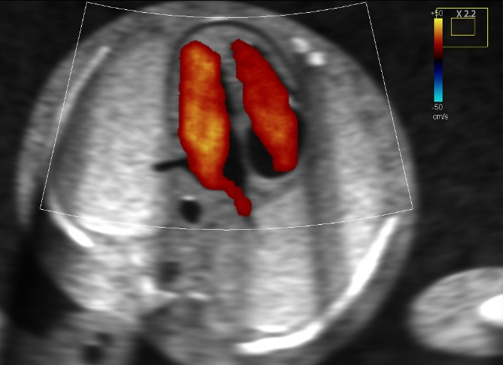 color doppler ultrasound